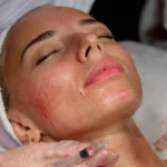 Dealing with Extreme Swelling After Microneedling