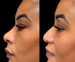 Non-Surgical Nose Job miami
