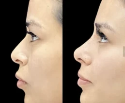 Non-Surgical Nose Job miami