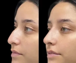 Non-Surgical Nose Job miami