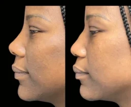 Non-Surgical Nose Job miami