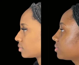 Non-Surgical Nose Job miami