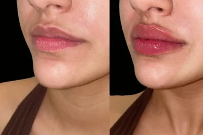 Lip Filler miami