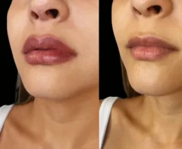 Lip Filler miami