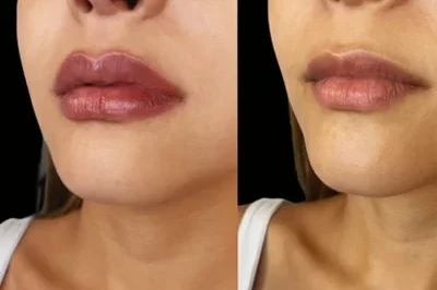 Lip Filler miami