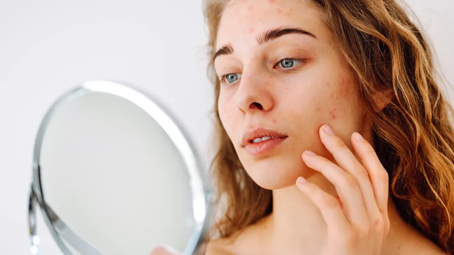 Does Collagen Help With Acne