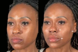 facial harmonization miami 01 61 Facial Harmonization miami 01