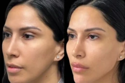 facial harmonization miami 04 60 Facial Harmonization miami 04