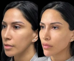 Facial Harmonization miami 04