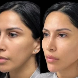 facial harmonization miami 04 72 Facial Harmonization miami 04