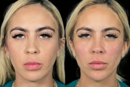 facial harmonization miami 05 62 Facial Harmonization miami 05