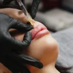 How Much Do Lip Fillers Cost in Miami