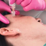 Microneedling for Acne Scars