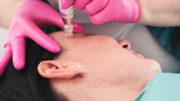 Microneedling for Acne Scars