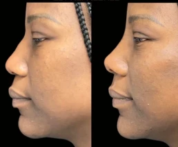Non Surgical Nose Job miami 01