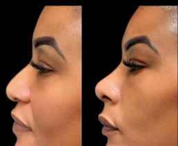 Non Surgical Nose Job miami 02