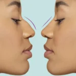 Bulbous Nose Tip Without Surgery