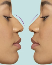 Bulbous Nose Tip Without Surgery