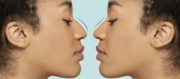 Bulbous Nose Tip Without Surgery