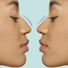 Bulbous Nose Tip Without Surgery