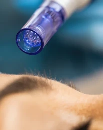 How to Treat Breakouts After Microneedling