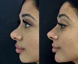 Non Surgical Nose Job Miami