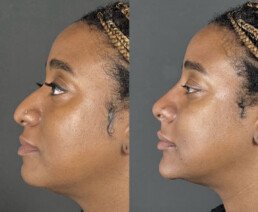 Non Surgical Nose Job Miami 02 B&A