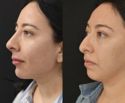 Non Surgical Nose Job Miami 03