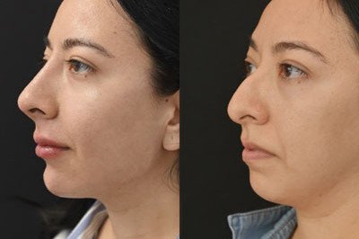 Non Surgical Nose Job Miami 03