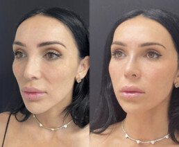 Non Surgical Nose Job Miami 04