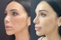 non surgical nose job miami 05 58 Non Surgical Nose Job Miami 05