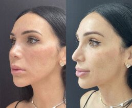 Non Surgical Nose Job Miami 05