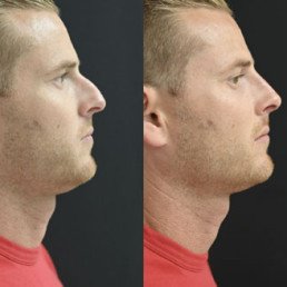 non surgical nose job miami 06 73 Non Surgical Nose Job Miami 06