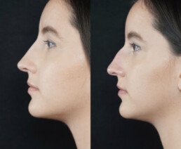 Non Surgical Nose Job Miami 08