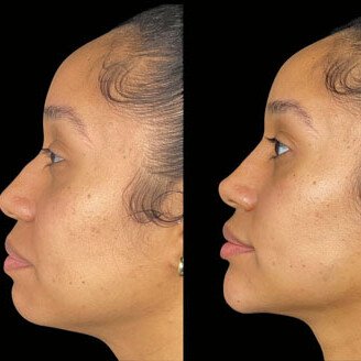 Chin & Jawline Filler miami 01