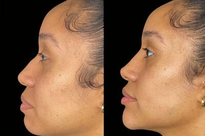 Chin & Jawline Filler miami 01
