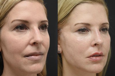 Facial Balancing miami 04