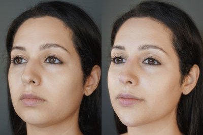 Facial Balancing miami 06
