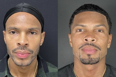 Facial Balancing miami 10