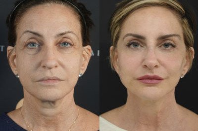 Facial Balancing miami 11