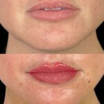 Lip Filler Miami 04
