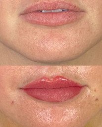Lip Filler Miami 04