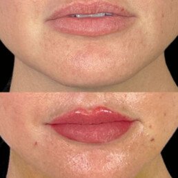 Lip Filler Miami 04