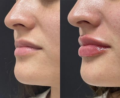 Lip Filler Miami 11