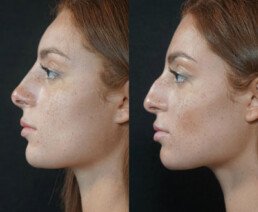 Non Surgical Nose Job Miami 07