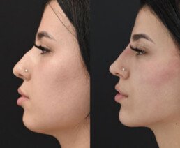 Non Surgical Nose Job Miami 09