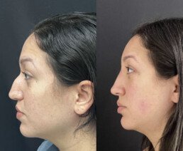 Non Surgical Nose Job Miami 10