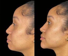 Non Surgical Nose Job Miami 11