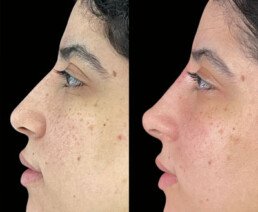 Non Surgical Nose Job Miami 12