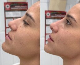 Non Surgical Nose Job Miami 13